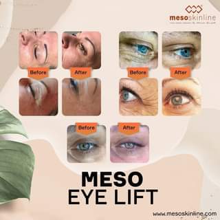 Read more about the article MESO EYE LIFT
 Visible lifting and healthy skin structure This treatment benefits: Anti-ageing, early signs of ageing.
 Reconstructs the face’s youthf…