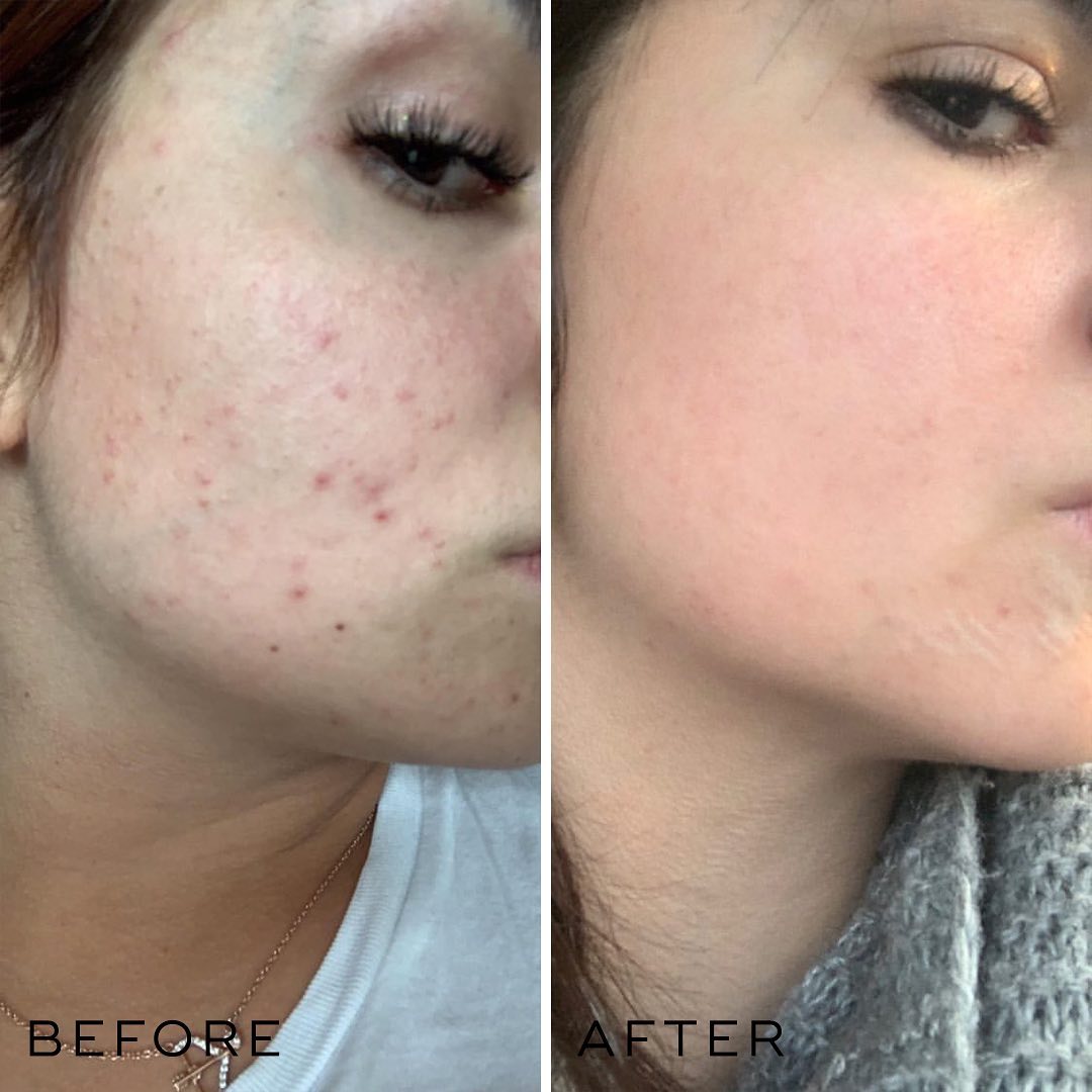 BLEMISH SKINCARE - We had to share @celiamattele 's secret to tackling...