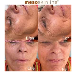 Read more about the article Beautiful skin with Mesoskinline!  www.mesoskinline.com.cy . . . . #mesoskinline #mesotherapy #skincare #bbglow #bbglowtreatment #antiagingskincare #p…