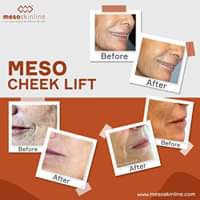 Read more about the article Everyone will notice. No one will know.
 MESO CHEEK LIFT
 activates cell reconstruction
 Lines caused by facial expressions are always visible. We use…