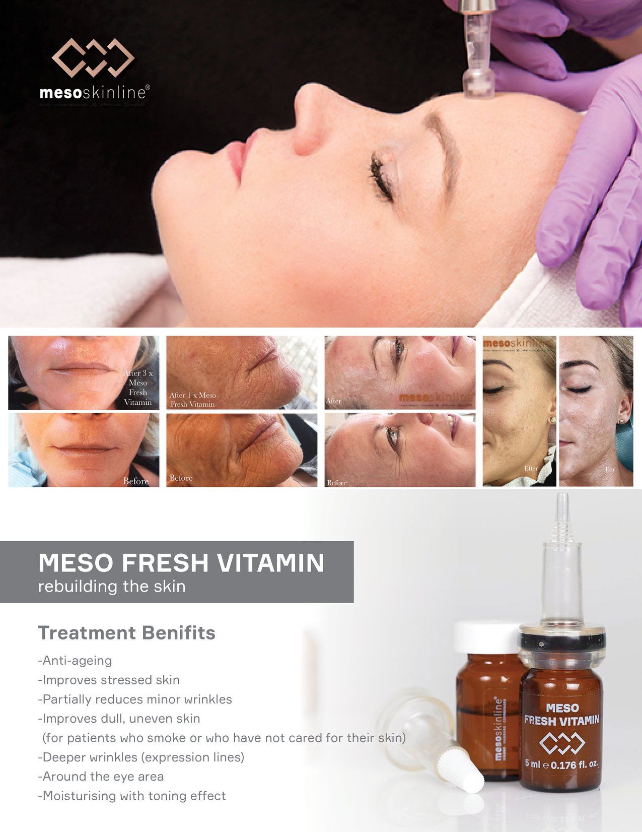 Read more about the article Fresh Skin is not overnight. It takes days of #skincareroutine and proper #discipline
 MESO FRESH VITAMIN is an important product within #noninvasivem…