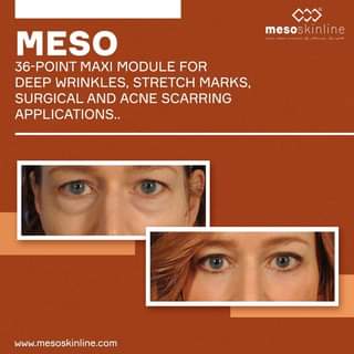Read more about the article MESO 36-Point Maxi Module For deep wrinkles, stretch marks, surgical and acne scarring applications.. The needles create invisible microscopic holes, …