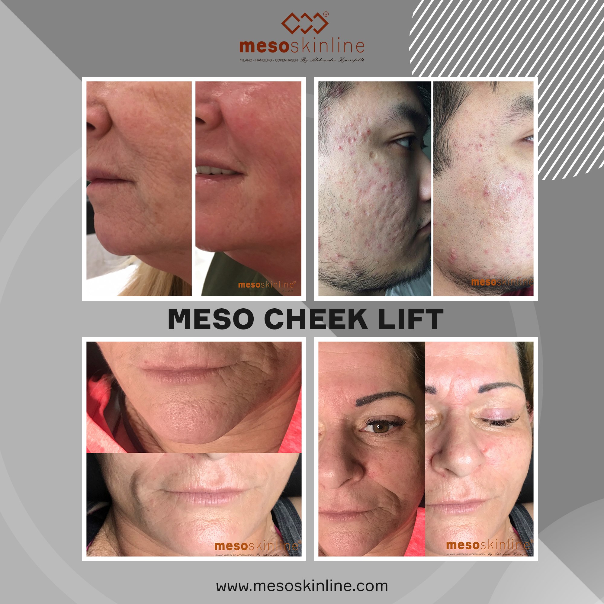 MESO CHEEK LIFT
 activates cell reconstruction
 Benefits
 • Age-killing effect particularly effective against expression lines
 • Visible deep wrinkle...