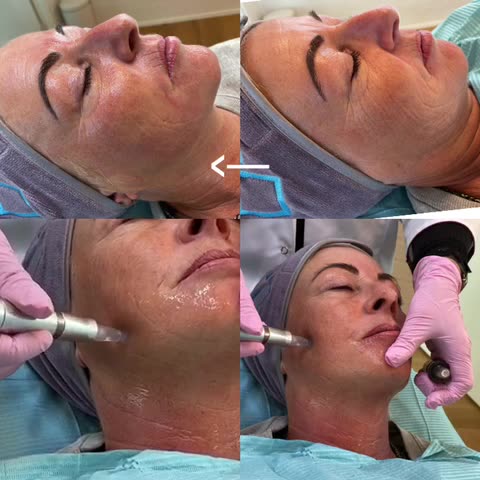 Read more about the article MESO CHEEK LIFT – mesoskinline