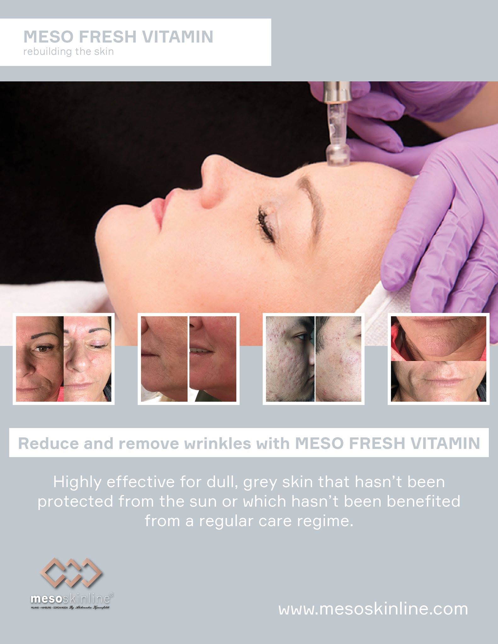 Read more about the article MESO FRESH VITAMIN is an important product within mesotherapy that stimulates and revives tired skin.
 The product is ideal for treating dehydration, …