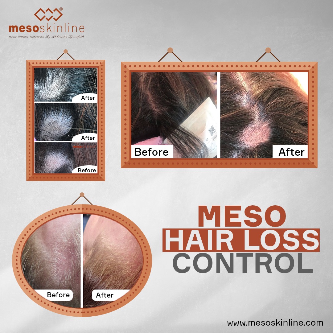 MESO HAIR LOSS CONTROL
 eight actions to redentify
 Reduce or stop hair loss in eight stages
 MESO HAIR LOSS CONTROL is a unique agent against hair lo...