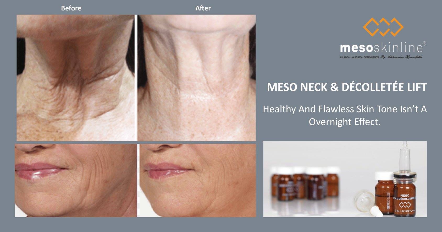 Read more about the article MESO NECK & DÉCOLLETÉE LIFT is very effective against clear lines and thin, saggy skin around the neck and décolleté.
 Learn more on our website h…