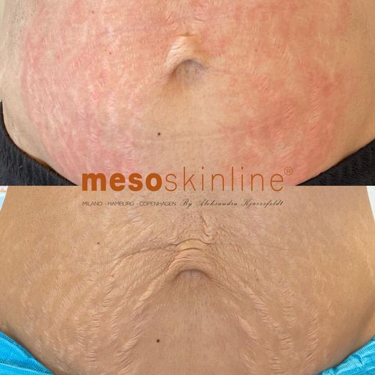 Read more about the article MESO STRETCH MARK REMOVER

Reduces stretch marks with MESO STRETCH MARK REMOVER
Regenerates the skin and reduce stretch marks (both white and red).

B…