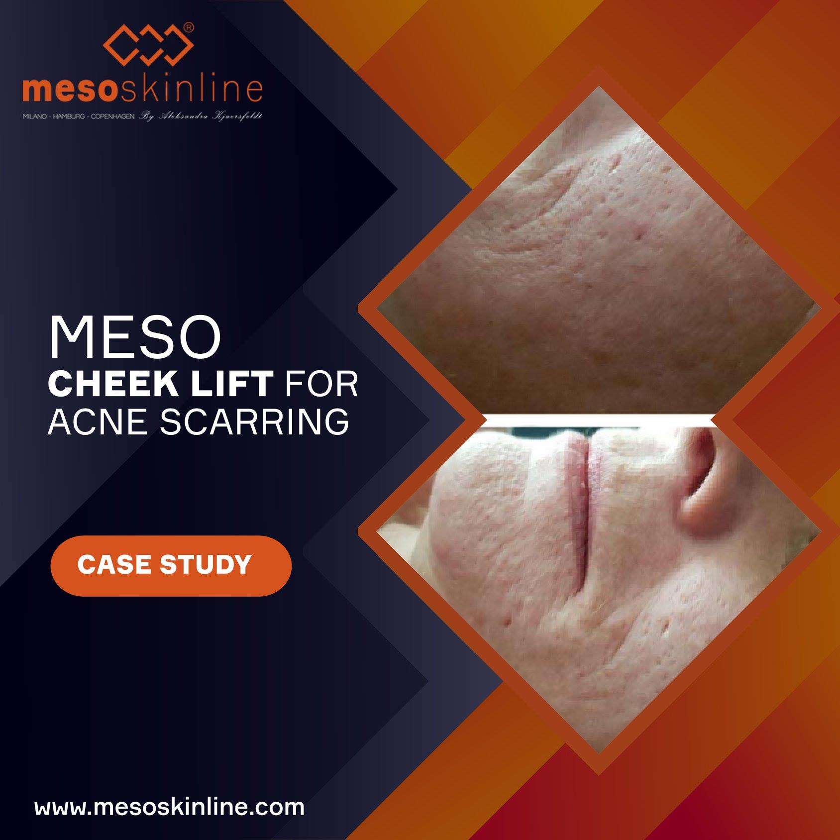 Meso Cheek lift for Acne Scarring
 My client for this case study is a 50-year-old female who suffered from acne as a teenager and as a result has been...