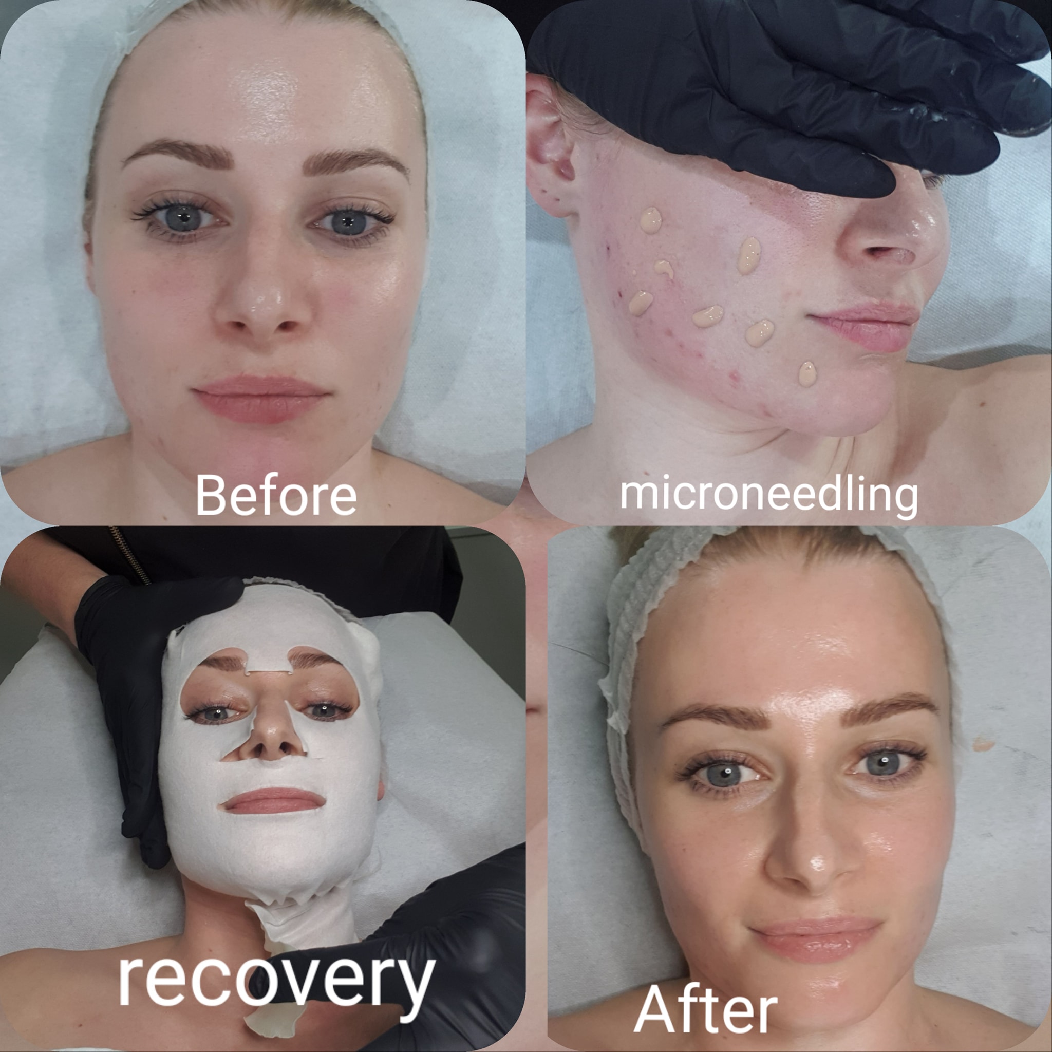 Read more about the article Meso Skin Perfector in action @ Episkopi Beauty By Jane