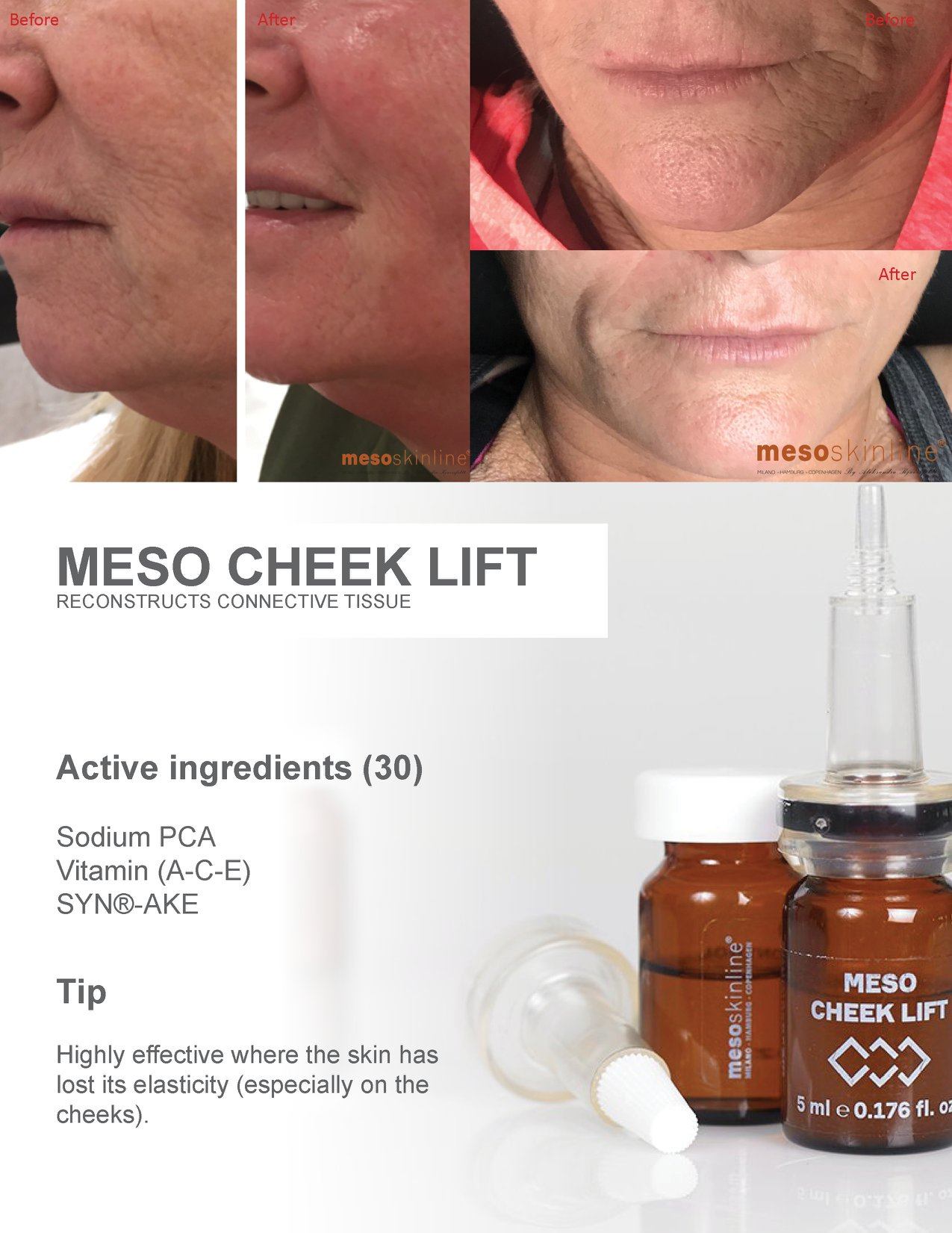 Read more about the article Recently Meso Cheek Lift surprised everyone from our therapists to the client.
 The Treatment was offered by our #danish clinic “Klinik Baarsø”. The c…