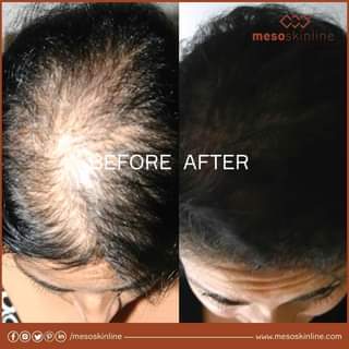 Read more about the article Reduce or stop hair loss in 8 stages – 1] Stimulates the microcirculation
 2] Affects 5a-reductase inhibitors
 3] Regulates the production of tallow
 …